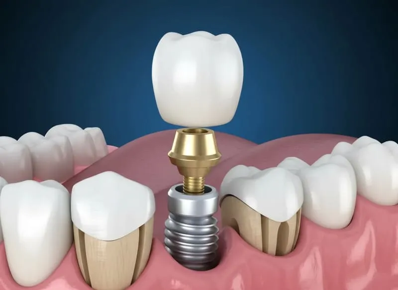 Bild zum Beitrag Implantat oder Br&uuml;cke