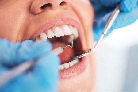 Zähne machen lassen - Ein umfassender Leitfaden