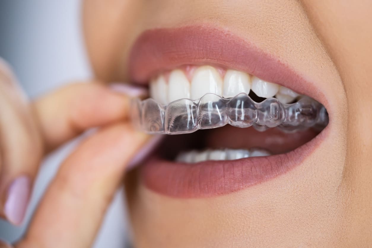 Zähne machen lassen: Die verschiedenen Optionen